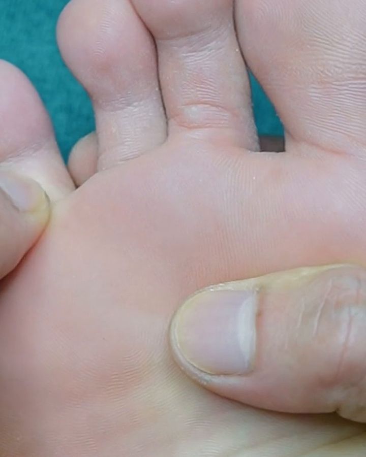 Two thumbs pressing the ball of a bare foot, below the toes